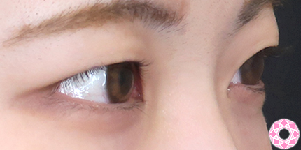 年代：20代 施術名：二重埋没法 施術前｜【公式】東京形成美容外科