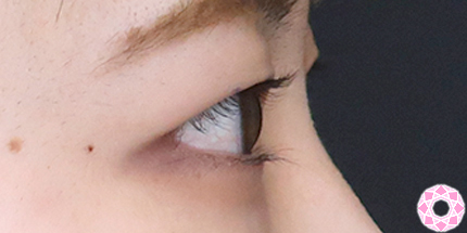 年代：20代 施術名：二重埋没法 施術前｜【公式】東京形成美容外科