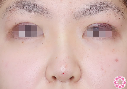 年代：10代 施術名：プチ隆鼻術（ヒアルロン酸） 施術後｜【公式】東京形成美容外科