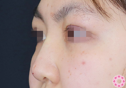 年代：10代 施術名：プチ隆鼻術（ヒアルロン酸） 施術後｜【公式】東京形成美容外科