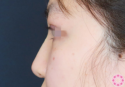 年代：10代 施術名：プチ隆鼻術（ヒアルロン酸） 施術後｜【公式】東京形成美容外科