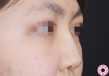 年代：10代 施術名：プチ隆鼻術（ヒアルロン酸） 施術後｜【公式】東京形成美容外科