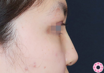 年代：10代 施術名：プチ隆鼻術（ヒアルロン酸） 施術後｜【公式】東京形成美容外科