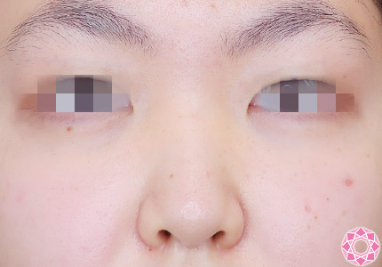 年代：10代 施術名：プチ隆鼻術（ヒアルロン酸） 施術前｜【公式】東京形成美容外科