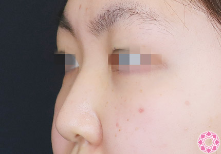 年代：10代 施術名：プチ隆鼻術（ヒアルロン酸） 施術前｜【公式】東京形成美容外科