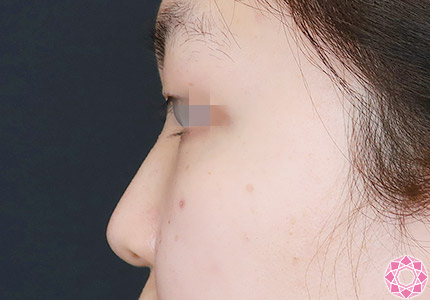 年代：10代 施術名：プチ隆鼻術（ヒアルロン酸） 施術前｜【公式】東京形成美容外科