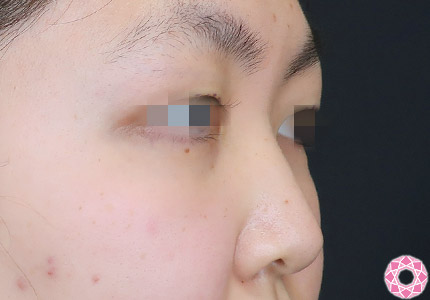 年代：10代 施術名：プチ隆鼻術（ヒアルロン酸） 施術前｜【公式】東京形成美容外科