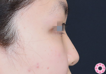 年代：10代 施術名：プチ隆鼻術（ヒアルロン酸） 施術前｜【公式】東京形成美容外科