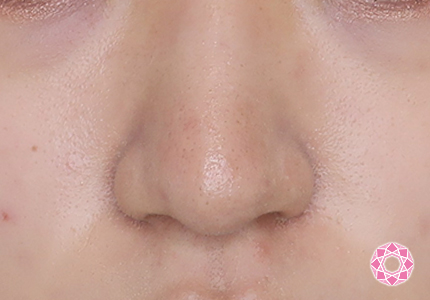 年代：10代 施術名：鼻先（ダンゴ鼻）修正 施術後｜【公式】東京形成美容外科