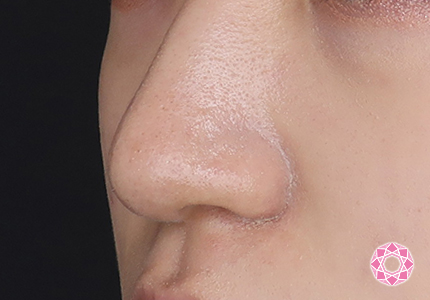 年代：10代 施術名：鼻先（ダンゴ鼻）修正 施術後｜【公式】東京形成美容外科