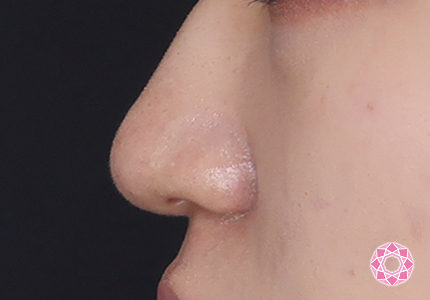 年代：10代 施術名：鼻先（ダンゴ鼻）修正 施術後｜【公式】東京形成美容外科