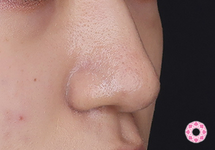 年代：10代 施術名：鼻先（ダンゴ鼻）修正 施術後｜【公式】東京形成美容外科