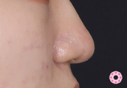 年代：10代 施術名：鼻先（ダンゴ鼻）修正 施術後｜【公式】東京形成美容外科