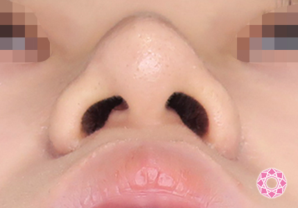 年代：10代 施術名：鼻先（ダンゴ鼻）修正 施術後｜【公式】東京形成美容外科