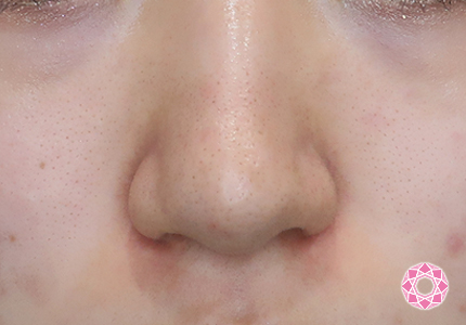 年代：10代 施術名：鼻先（ダンゴ鼻）修正 施術前｜【公式】東京形成美容外科