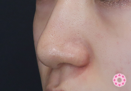 年代：10代 施術名：鼻先（ダンゴ鼻）修正 施術前｜【公式】東京形成美容外科