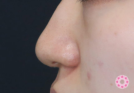 年代：10代 施術名：鼻先（ダンゴ鼻）修正 施術前｜【公式】東京形成美容外科