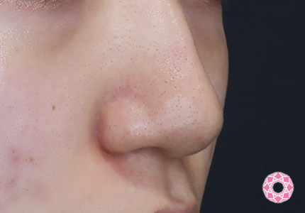 年代：10代 施術名：鼻先（ダンゴ鼻）修正 施術前｜【公式】東京形成美容外科