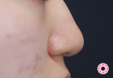 年代：10代 施術名：鼻先（ダンゴ鼻）修正 施術前｜【公式】東京形成美容外科