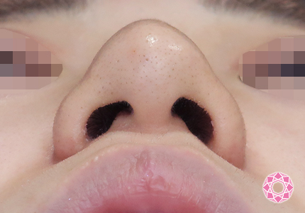 年代：10代 施術名：鼻先（ダンゴ鼻）修正 施術前｜【公式】東京形成美容外科