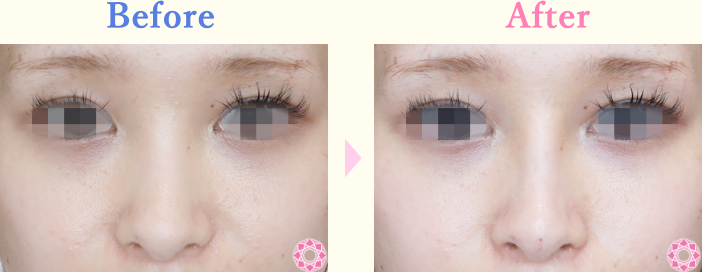 年代：20代 施術名：プチ隆鼻術（ヒアルロン酸） 施術前後｜【公式】東京形成美容外科