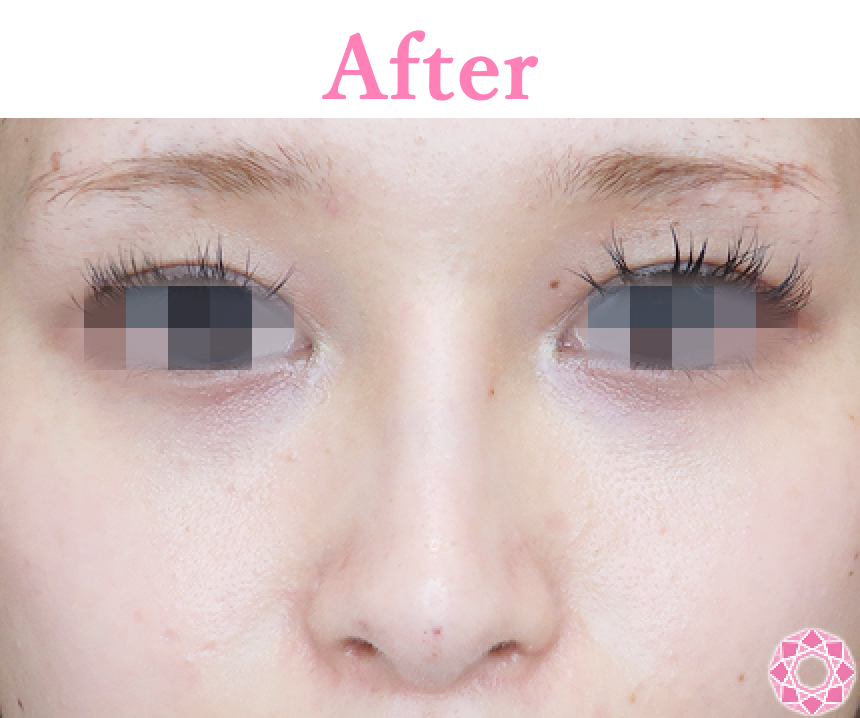 年代：20代 施術名：プチ隆鼻術（ヒアルロン酸） 施術後 拡大画像｜【公式】東京形成美容外科