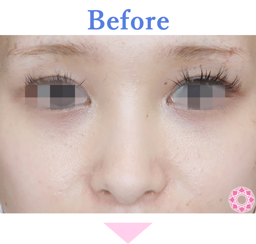 年代：20代 施術名：プチ隆鼻術（ヒアルロン酸） 施術前 拡大画像｜【公式】東京形成美容外科