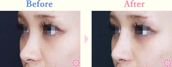 年代：20代 施術名：プチ隆鼻術（ヒアルロン酸） 施術前後｜【公式】東京形成美容外科