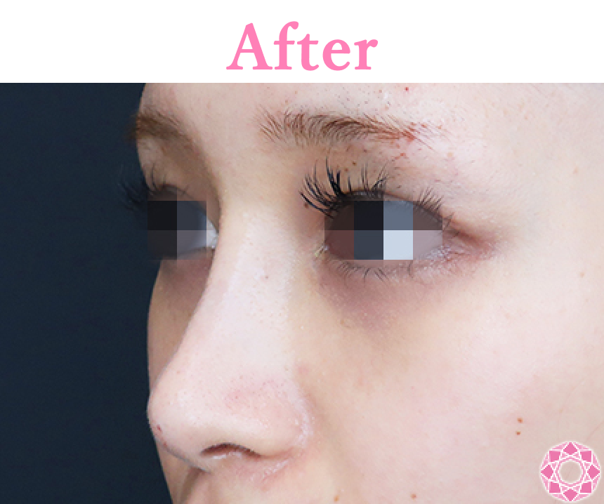 年代：20代 施術名：プチ隆鼻術（ヒアルロン酸） 施術後 拡大画像｜【公式】東京形成美容外科