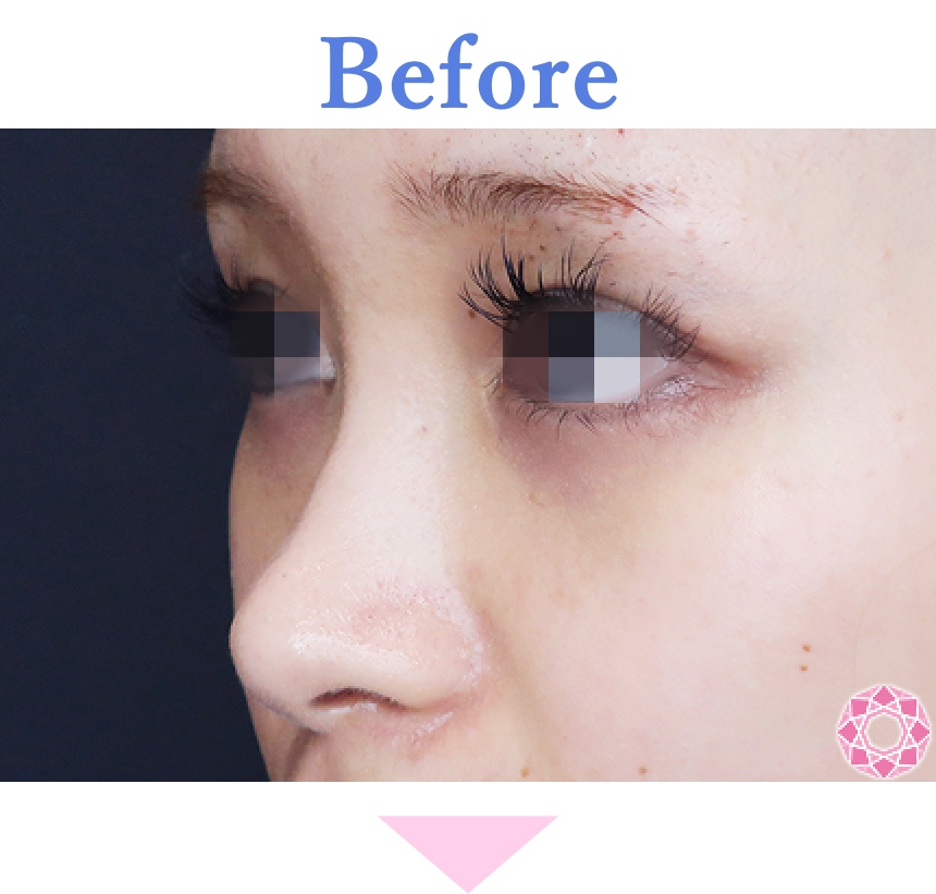 年代：20代 施術名：プチ隆鼻術（ヒアルロン酸） 施術前 拡大画像｜【公式】東京形成美容外科