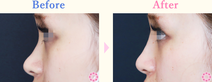 年代：20代 施術名：プチ隆鼻術（ヒアルロン酸） 施術前後｜【公式】東京形成美容外科