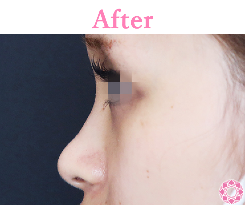 年代：20代 施術名：プチ隆鼻術（ヒアルロン酸） 施術後 拡大画像｜【公式】東京形成美容外科