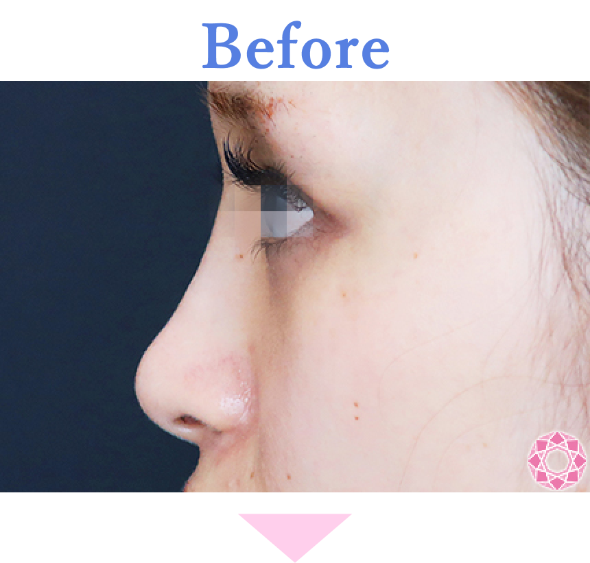 年代：20代 施術名：プチ隆鼻術（ヒアルロン酸） 施術前 拡大画像｜【公式】東京形成美容外科