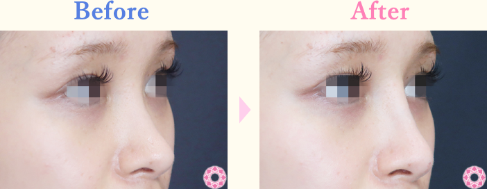 年代：20代 施術名：プチ隆鼻術（ヒアルロン酸） 施術前後｜【公式】東京形成美容外科