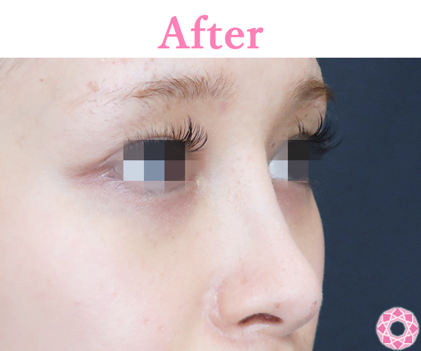 年代：20代 施術名：プチ隆鼻術（ヒアルロン酸） 施術後 拡大画像｜【公式】東京形成美容外科