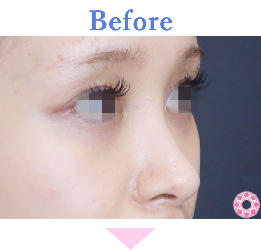 年代：20代 施術名：プチ隆鼻術（ヒアルロン酸） 施術前 拡大画像｜【公式】東京形成美容外科