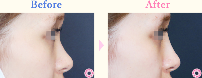 年代：20代 施術名：プチ隆鼻術（ヒアルロン酸） 施術前後｜【公式】東京形成美容外科