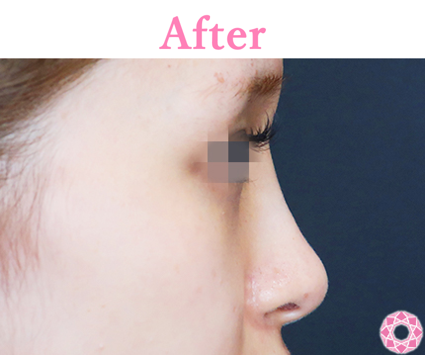 年代：20代 施術名：プチ隆鼻術（ヒアルロン酸） 施術後 拡大画像｜【公式】東京形成美容外科