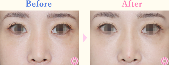 年代：30代 施術名：プチ隆鼻術（ヒアルロン酸） 施術前後｜【公式】東京形成美容外科