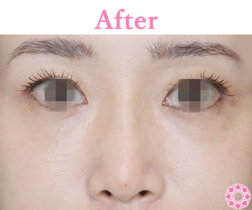 年代：30代 施術名：プチ隆鼻術（ヒアルロン酸） 施術後 拡大画像｜【公式】東京形成美容外科