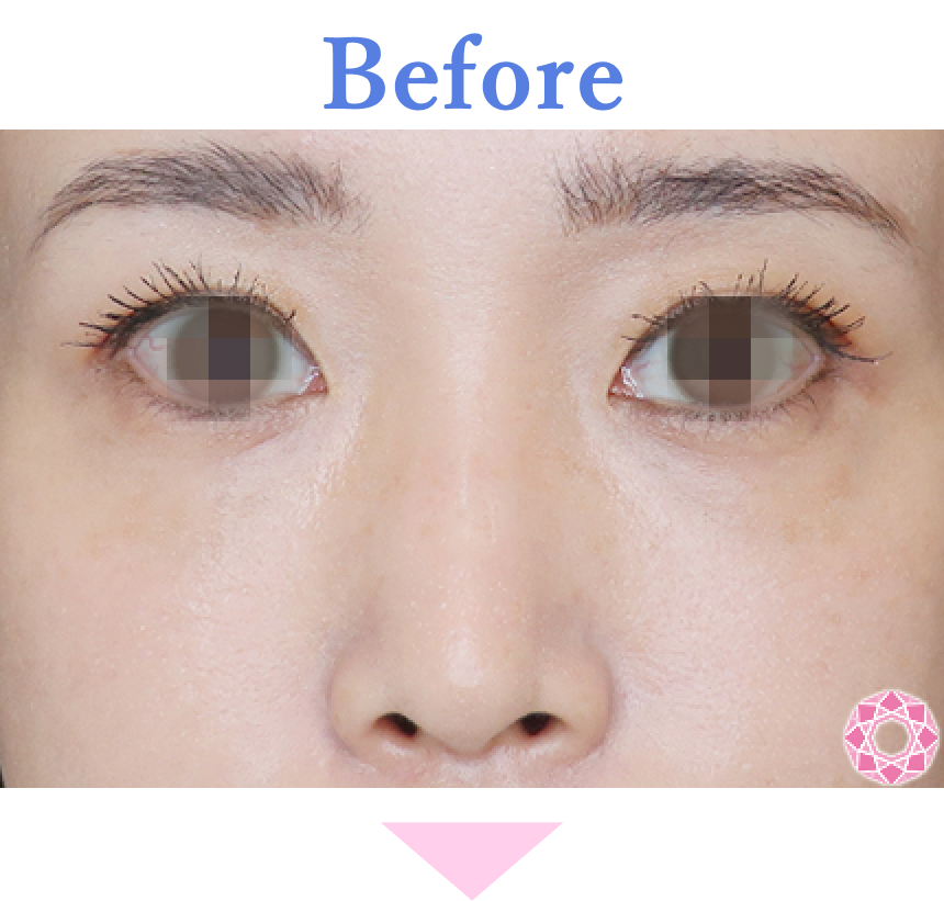 年代：30代 施術名：プチ隆鼻術（ヒアルロン酸） 施術前 拡大画像｜【公式】東京形成美容外科