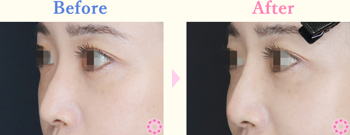 年代：30代 施術名：プチ隆鼻術（ヒアルロン酸） 施術前後｜【公式】東京形成美容外科