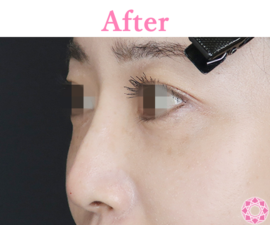 年代：30代 施術名：プチ隆鼻術（ヒアルロン酸） 施術後 拡大画像｜【公式】東京形成美容外科