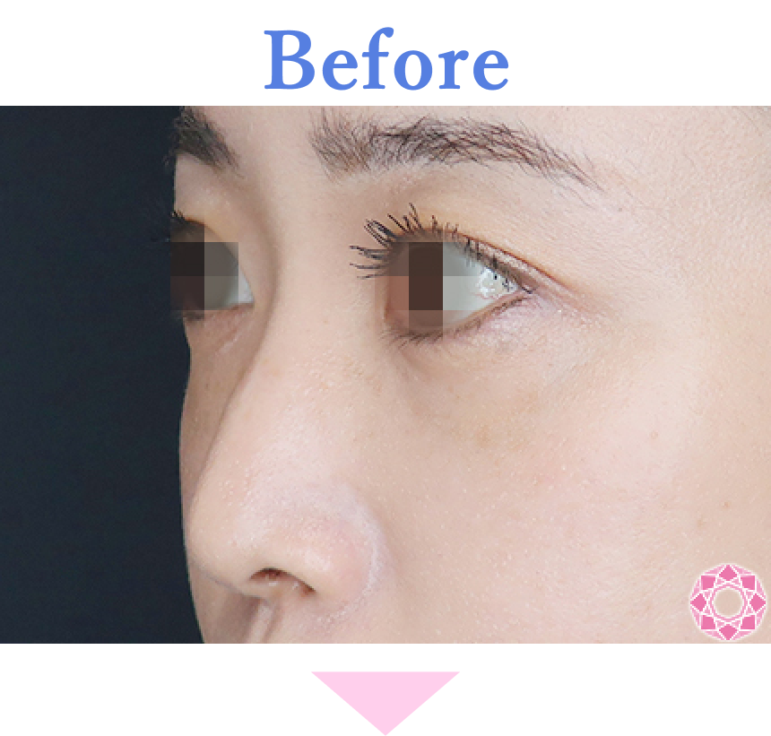 年代：30代 施術名：プチ隆鼻術（ヒアルロン酸） 施術前 拡大画像｜【公式】東京形成美容外科