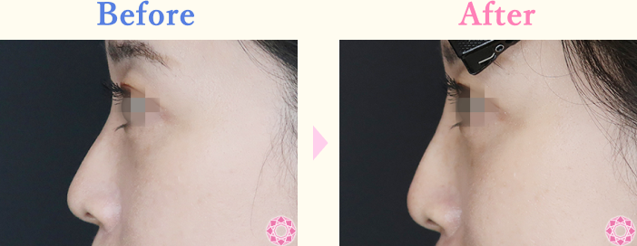 年代：30代 施術名：プチ隆鼻術（ヒアルロン酸） 施術前後｜【公式】東京形成美容外科