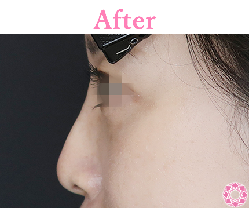 年代：30代 施術名：プチ隆鼻術（ヒアルロン酸） 施術後 拡大画像｜【公式】東京形成美容外科