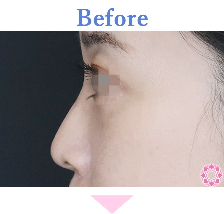 年代：30代 施術名：プチ隆鼻術（ヒアルロン酸） 施術前 拡大画像｜【公式】東京形成美容外科