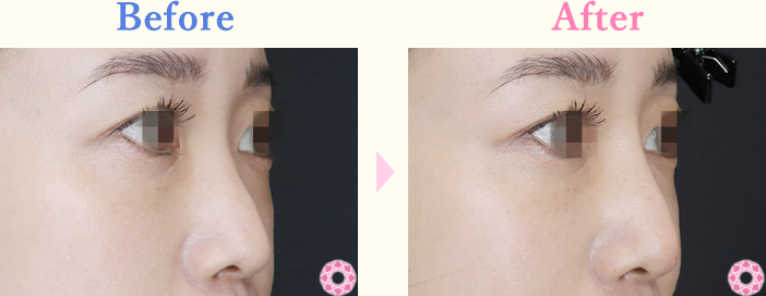 年代：30代 施術名：プチ隆鼻術（ヒアルロン酸） 施術前後｜【公式】東京形成美容外科