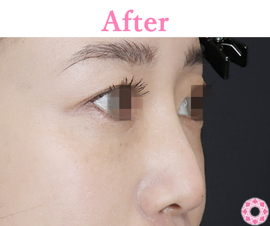 年代：30代 施術名：プチ隆鼻術（ヒアルロン酸） 施術後 拡大画像｜【公式】東京形成美容外科