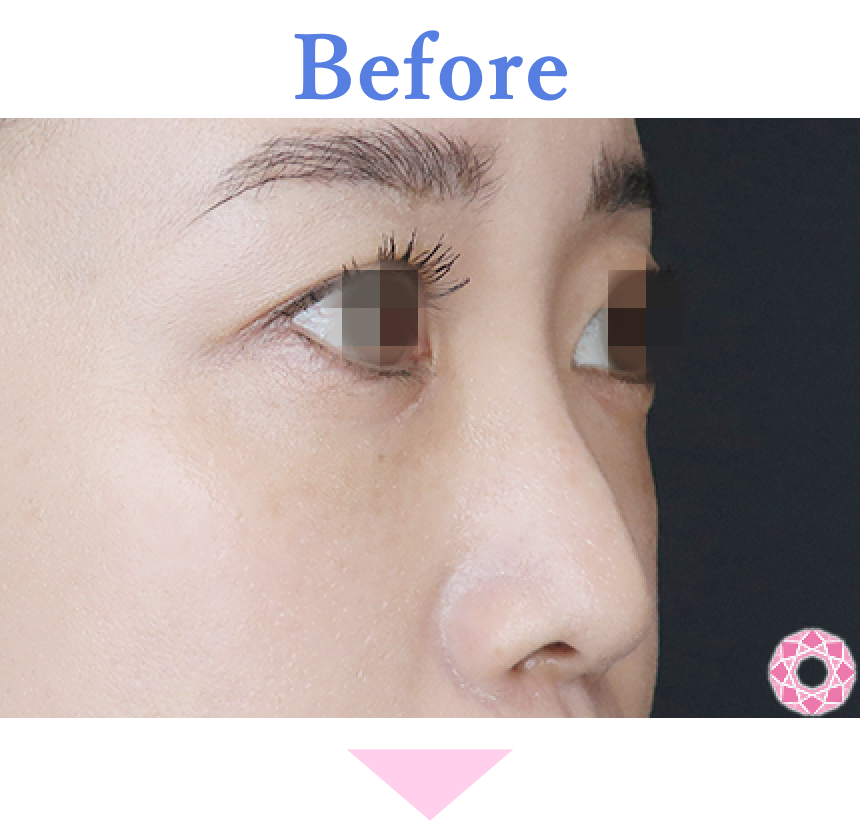 年代：30代 施術名：プチ隆鼻術（ヒアルロン酸） 施術前 拡大画像｜【公式】東京形成美容外科